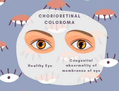 Chorioretinal coloboma