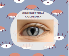 Chorioretinal coloboma