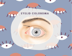 eyelid coloboma