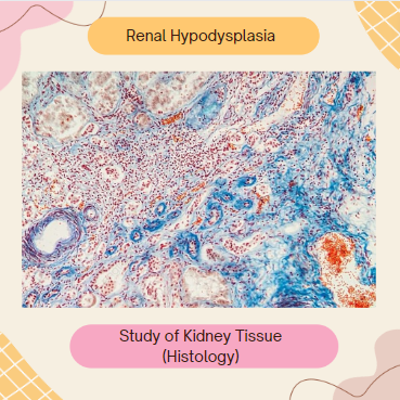 Renal coloboma 