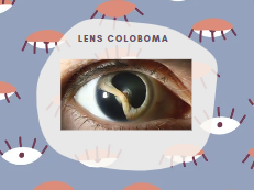 Lens coloboma