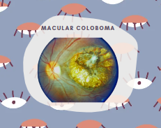 Macular coloboma