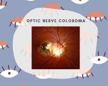 optic nerve coloboma