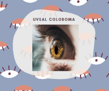 Uveal coloboma
